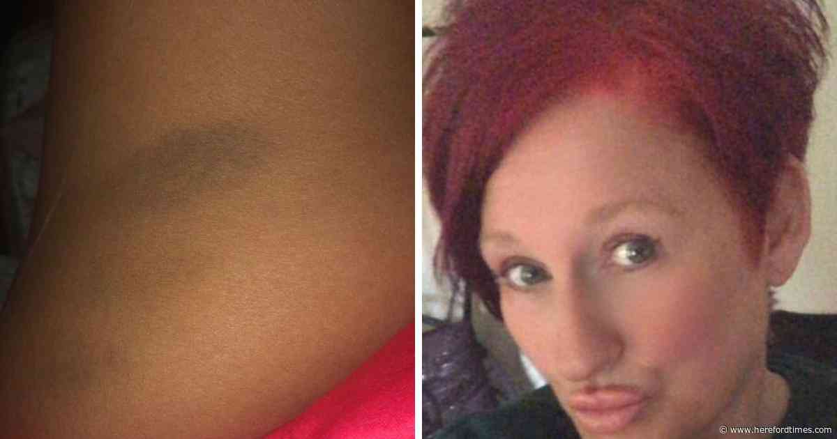 Woman left with bruises after 'nightmare' 30-hour wait at hospital