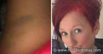 Woman left with bruises after 'nightmare' 30-hour wait at hospital
