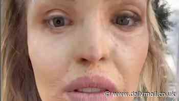 Katie Piper shows off her new glass eye in remarkable before and after shots after travelling to Hamburg for pioneering treatment