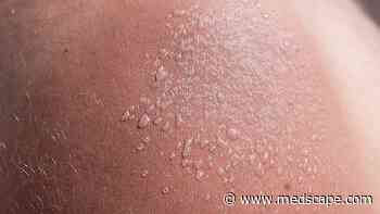 Childhood Sunburns Linked to Future Melanoma Risk