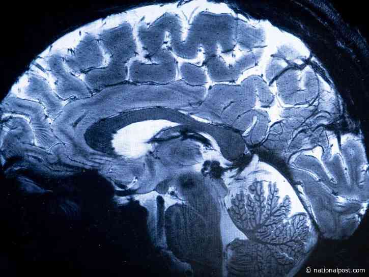 That mystery brain disease plaguing people in New Brunswick? A new study finds it's not real