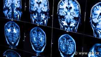 New Brunswick has no mystery neurological disease, scientific study concludes
