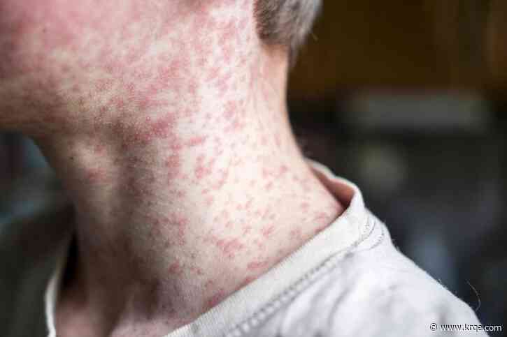 MAP: 11th state confirms measles outbreak as virus spreads