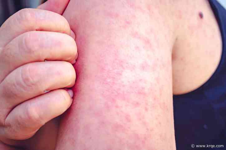 Curry County infant tests positive for measles