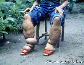 Anti-parasitic drug could accelerate the elimination of infection endemic to Africa
