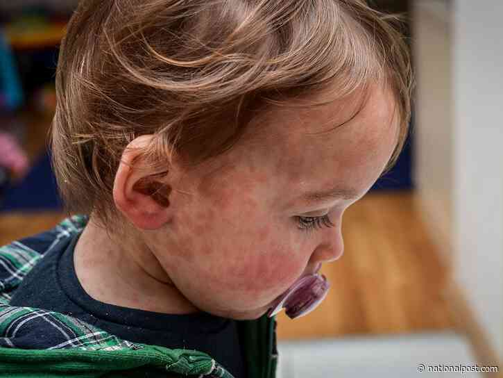 Only 7 in 10 Ontario kids vaccinated against measles, rates falling elsewhere. Here's why