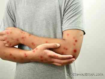 More measles cases in Ottawa likely as counts grow in Ontario, around world