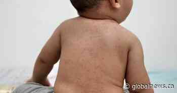 Measles cases show signs of exponential growth in western Canada, say health experts