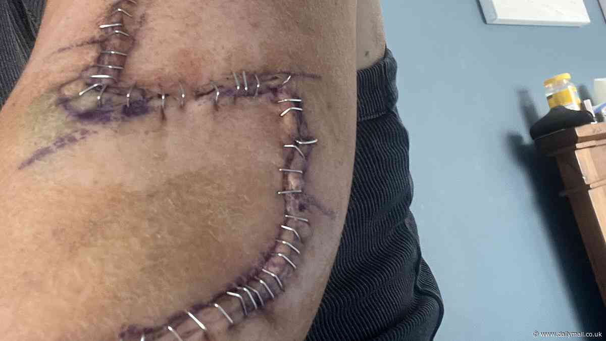 Pictured: The 'normal' mole on mother's arm that turned out to be deadliest skin cancer - she ignored it for 4 years