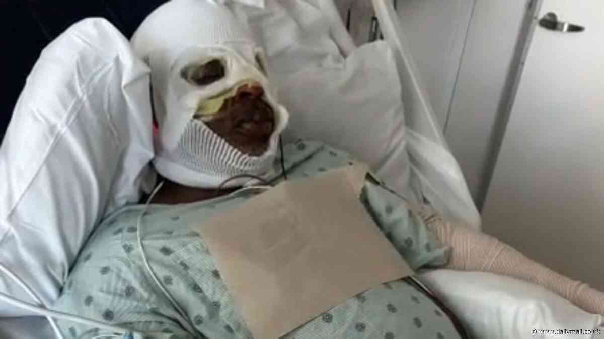 Louisiana father left with gruesome face and body burns after boat exploded at popular event