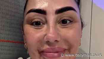 Sophie Kasaei shows off dramatic results of getting face filler dissolved at £30m Botox clinic after an allergic reaction left her with PTSD