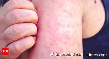 Measles cases in the US crosses 1,000: Early symptoms, prevention tips to know