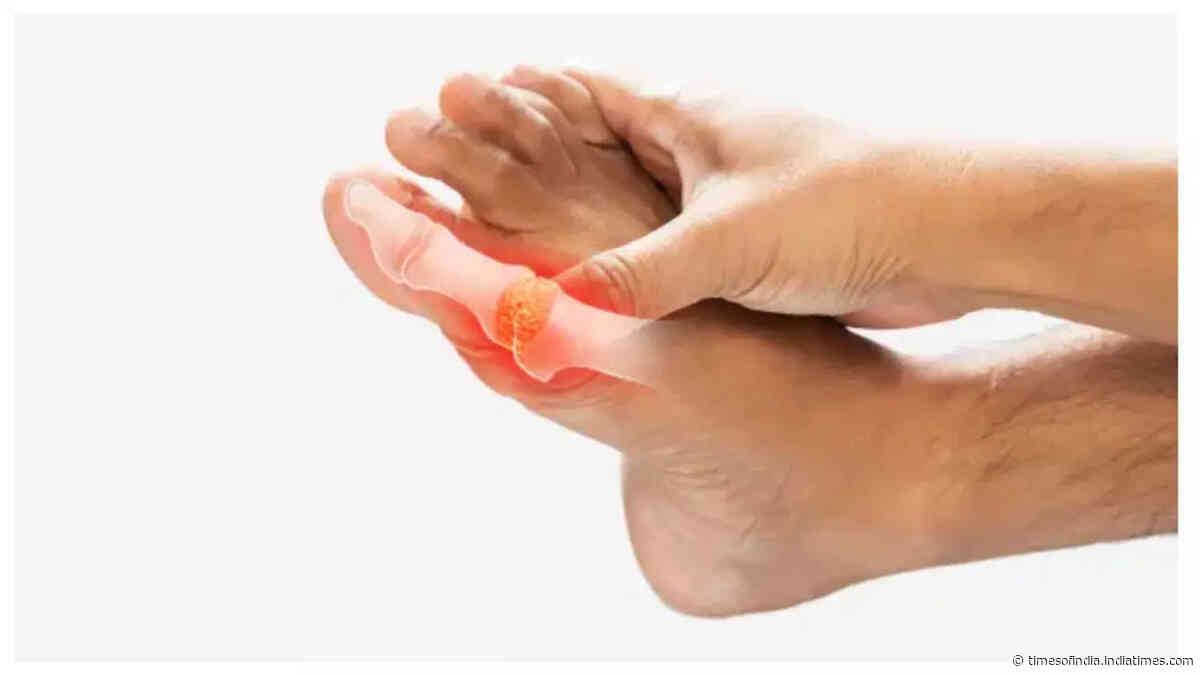 High uric acid level linked to sudden heart attacks: 7 ways to bring it down