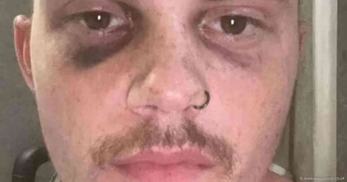 ‘My £300,000 ketamine addiction has ruined my life - now I am 24 with no bladder'