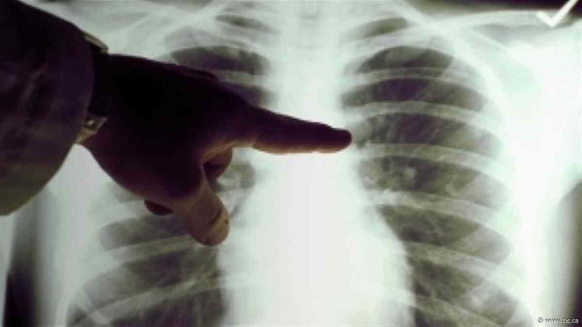 Tuberculosis, syphilis cases on the rise in Montreal