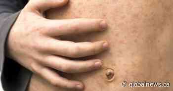 Ontario high school closes after measles exposure reported on campus