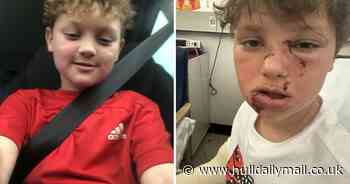 Eight-year-old Goole boy ‘recovering well’ after surgery following dog attack
