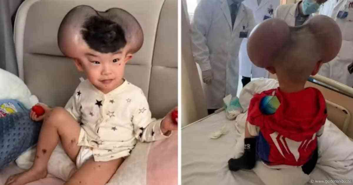 Jongetje (3) met bijnaam Mickey Mouse transformeert door operatie voor zeldzame aandoening