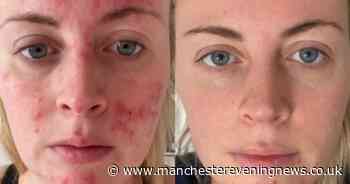 Scientists in Yorkshire accidentally discover water ingredient that 'clears skin'