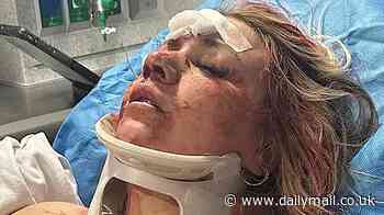Astonishing wedding day transformation of bride who was beaten bloody in brutal bachelorette party attack