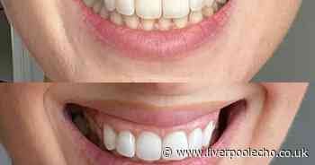 Shoppers who 'didn't want to smile' get 'much whiter' teeth in days with 20% off kit