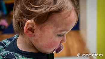 Parents of babies worry about measles exposure in Manitoba outbreak