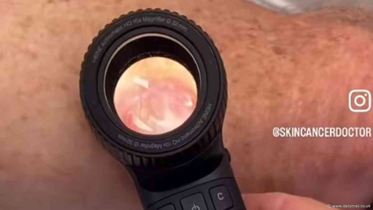 Skin cancer doctor shares shocking video of 'worst melanoma' he's ever seen: 'They don't always look like moles'