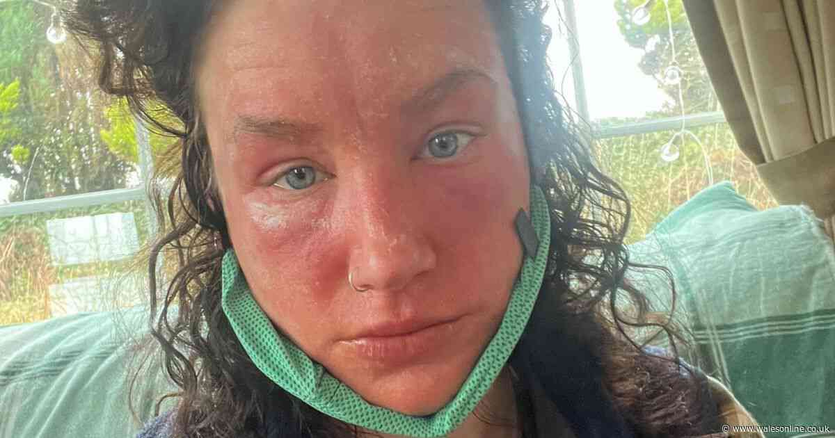 Woman who had 'small rash' now 'looks like she's burnt' after reaction
