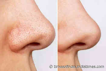 5 desi hacks to get rid of Blackheads