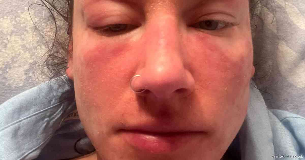 Woman's skin 'constantly on fire' after extreme reaction to commonly-used cream